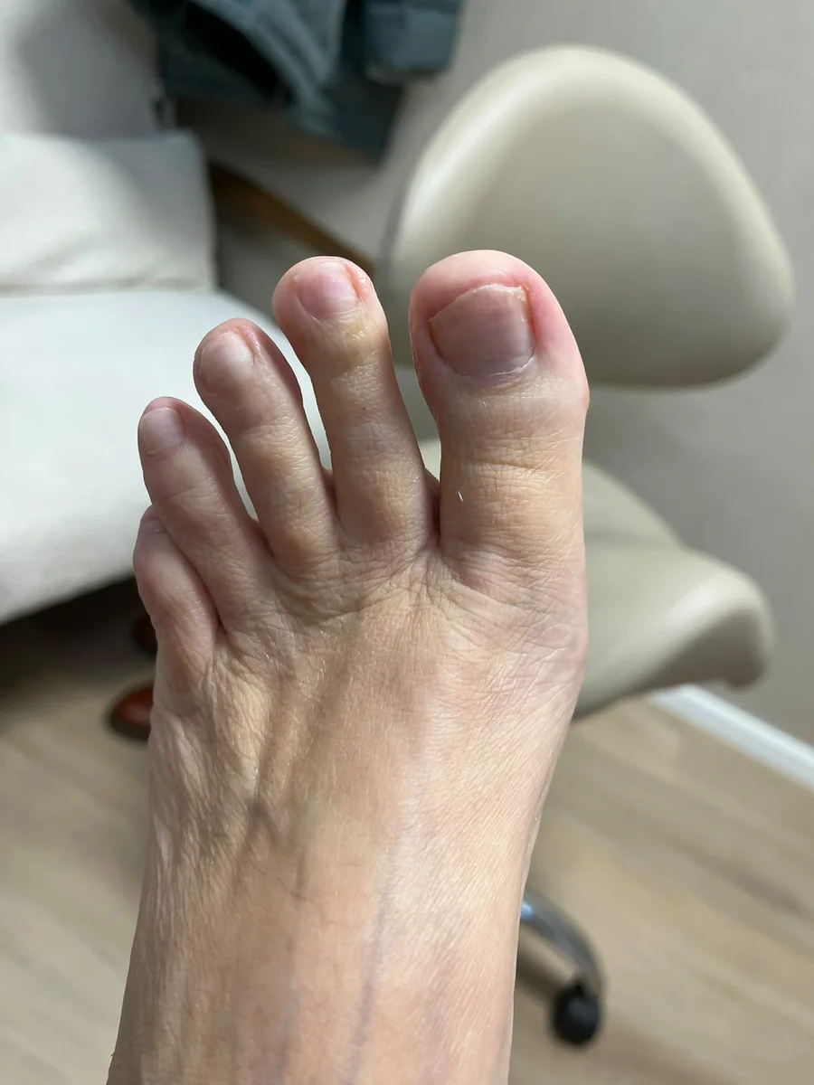 Vijf maanden later: gladde nagels met een egale kleur