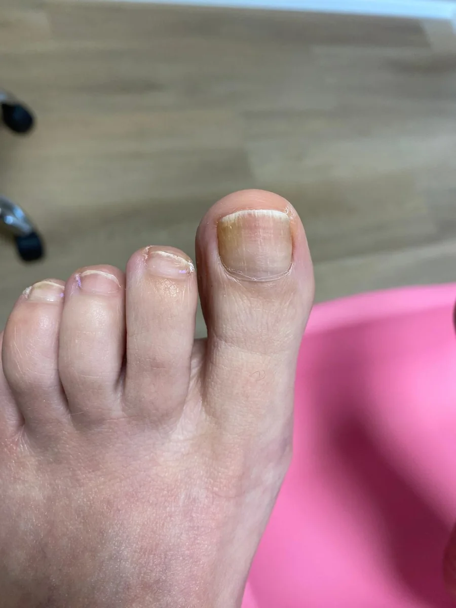 Voor: beginnende schimmelnagel met witte streepjes in de rand en gele verkleuring